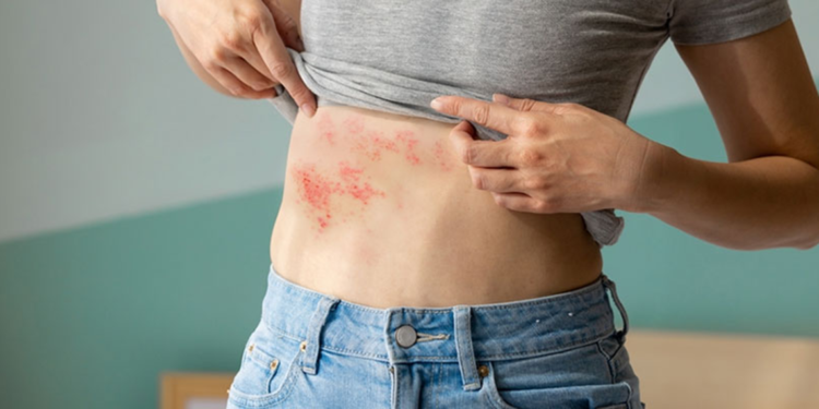 Stres ve yorgunluk gibi faktörler zona virüsünü tetikliyor