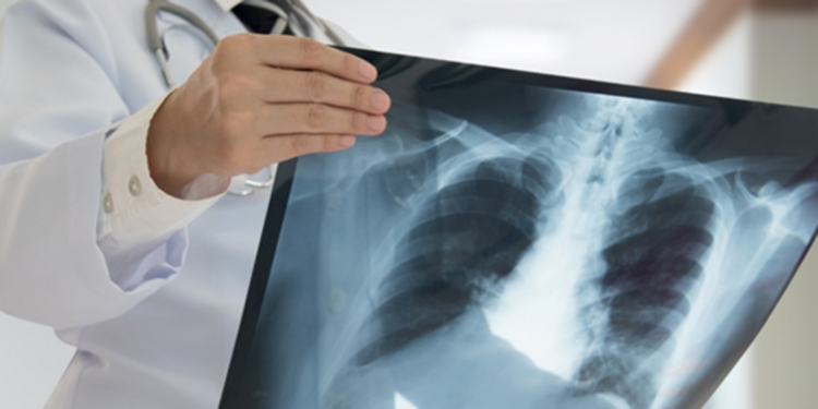 Türkiye'de tüberküloz oranı düşüşte