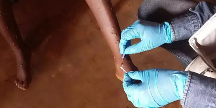 Uganda'da maymun çiçeği salgını; 37 ölü