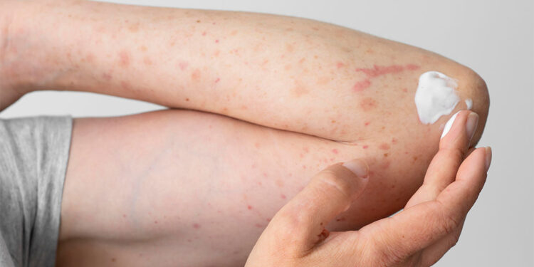 Zona hastası olanların yüzde 70'i 50 yaşın üzerinde