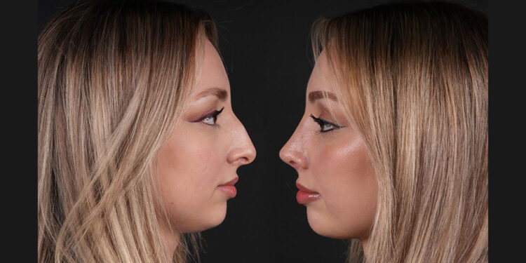 Romatolojik hastalıklar gibi sağlık sorunları varsa, burun estetiği ameliyatı yapmıyoruz