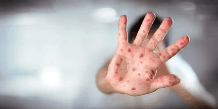 ABD'deki kızamık salgınında vaka sayısı 624'e yükseldi