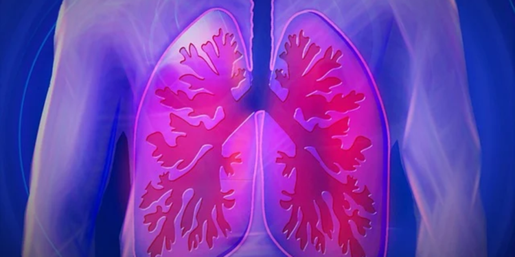 Beslenme alışkanlıkları, akciğer kanseriyle bağlantılı olabilir