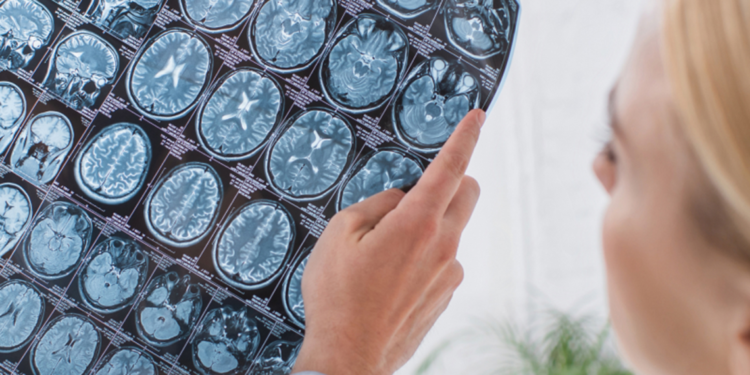 Beyin kanaması sonrası kafatasının bir kısmını midesinde taşıdı