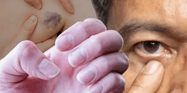 Demir eksikliği birçok hastalığa davetiye çıkartıyor