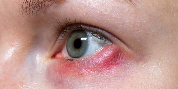 Göz kapaklarında kızarıklık ve şişlik blefarit belirtisi olabilir