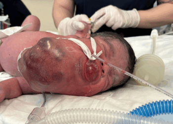 34 haftalık doğan Eymen bebeğin boynundan 445 gram tümör çıkarıldı