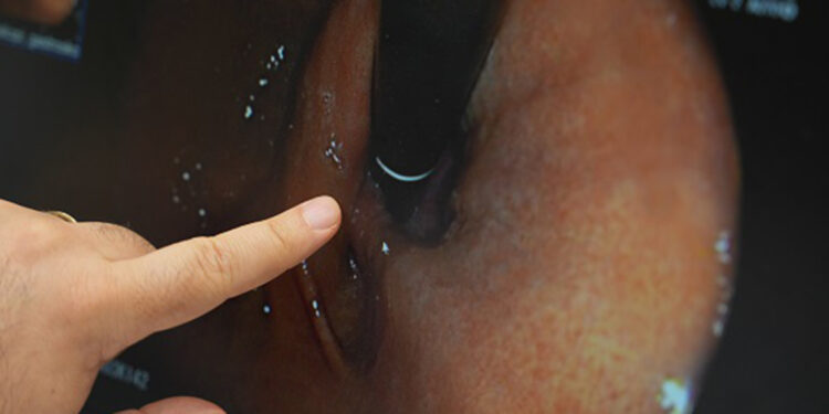 Bağırsak hastalıkları doğru tedavi ile kontrol altına alınabilir