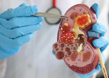 Böbrek taşları, Türkiye için önemli bir sağlık sorunu haline geldi