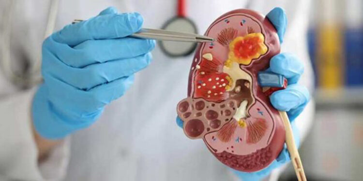 Böbrek taşları, Türkiye için önemli bir sağlık sorunu haline geldi