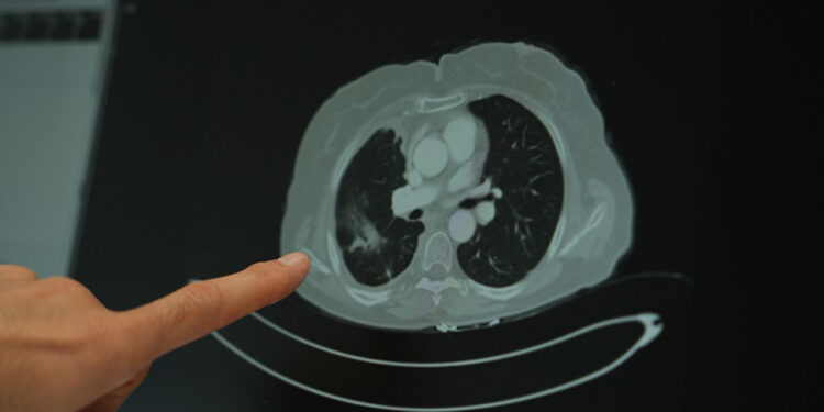 Genç yaş grubunda kanser vakalarında artış yaşanıyor