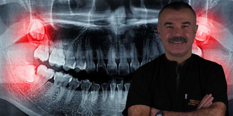 Yirmilik dişler zamanında çekilmezse diğer dişlerin formunu bozabilir