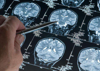 Alzheimer araştırmalarında riski artıran genetik varyant bulundu
