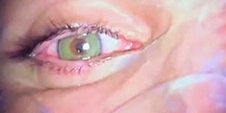 Göz rengini kalıcı olarak değiştirmek mümkün