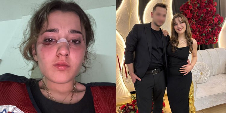 Tatil dönüş planı tartışmasında nişanlısını plajda motosiklet kaskıyla dövdü