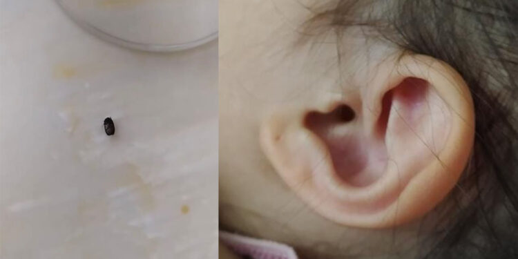 Kız çocuğunun kulağına kene yapıştı