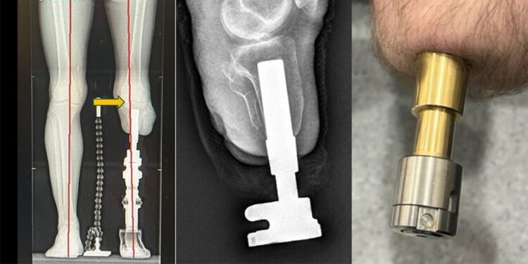 Osseoıntegrasyon sayesinde doğal yürüyüş mümkün