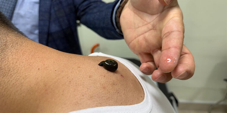 Sülük salgısıyla kalp krizi riskine karşı alternatif tedavi