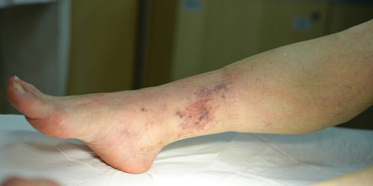 Varis tedavi edilmediğinde ciddi sağlık sorunlarına yol açıyor