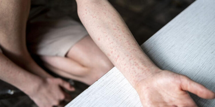 ABD'de kızamık vakaları artıyor