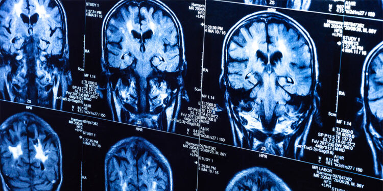 Covid-19 insanların beyinlerini yaşlandırdı