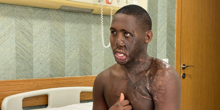 Yüzü yanan Ugandalı çoban Ankara'da tedavi edildi