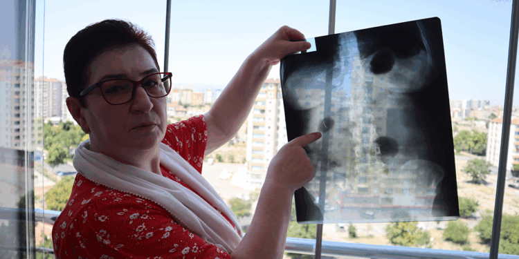 22 yıldır karnında ameliyat iğnesiyle yaşıyor