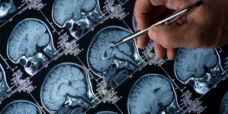 Alzheimer tedavisinde 'lityum' umudu