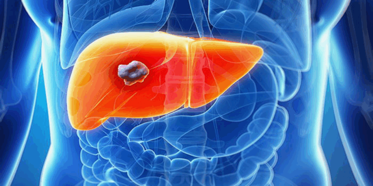 Araştırmaya göre karaciğer kanseri vakalarının en az yüzde 60’ı önlenebilir
