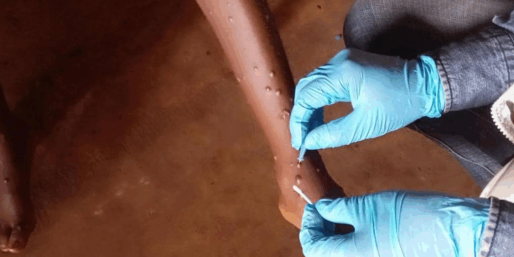 Gana'da M-çiçeği vaka sayısı 302'ye yükseldi