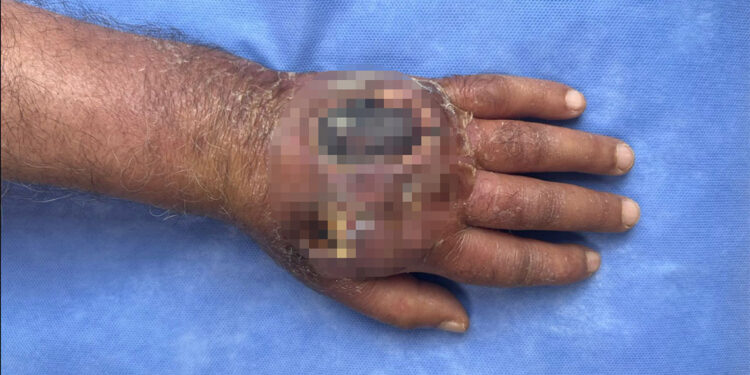 Hırsızın ısırığı kolundan ediyordu; vaka literatüre girmeye aday 