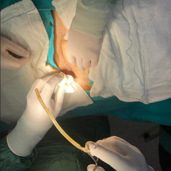 Karnında dren hortumu unutuldu; doktordan skandal sözler!