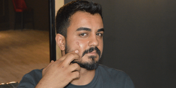 Lazer epilasyonda yüzü yandı, işletme hakkında şikayetçi oldu