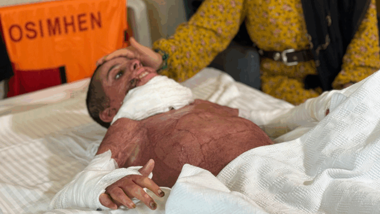 Vücudunun yüzde 50'si yanan Mustafa, yapay deri nakliyle hayata tutundu