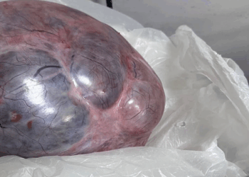 Yumurtalıklarındaki 9 kiloluk kitle operasyonla çıkarıldı