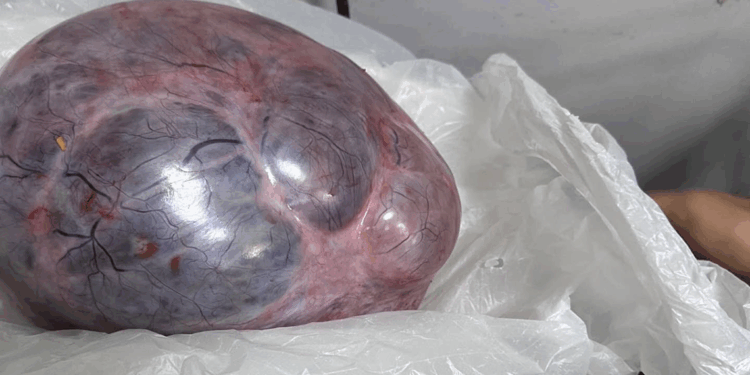 Yumurtalıklarındaki 9 kiloluk kitle operasyonla çıkarıldı