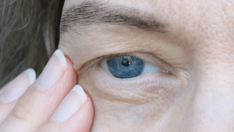 Göz kapaklarındaki sarkmalar görme güçlüğüne yol açabiliyor
