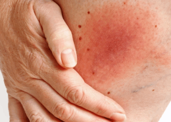 Lyme hastalığı kalıcı ve ağır tablolarla ilerleyebilir