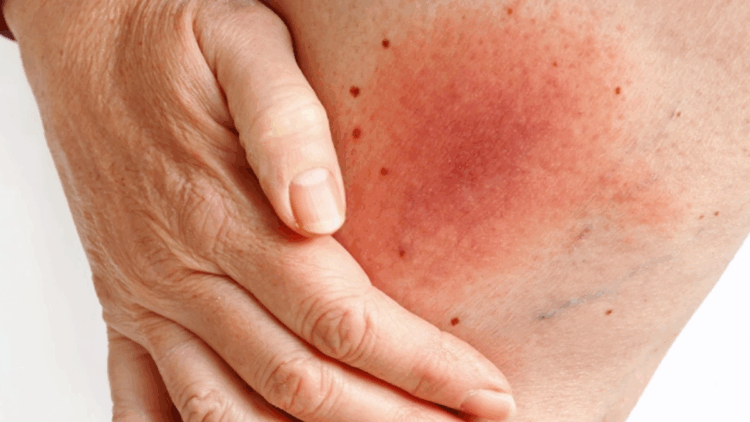 Lyme hastalığı kalıcı ve ağır tablolarla ilerleyebilir