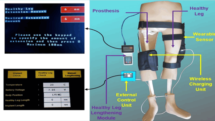 Türk akademisyenler, kemik kanseri tedavisi için tümör protezi geliştirdi