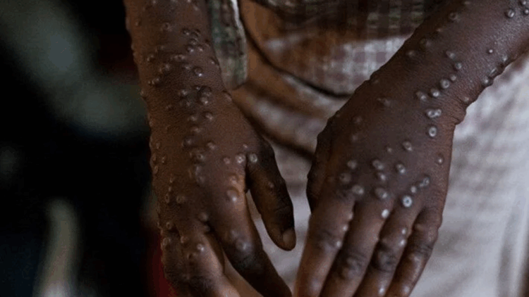 Gana'da maymun çiçeği virüsü vaka sayısı 583’e yükseldi