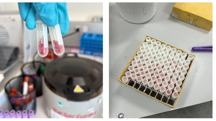 Talasemi hastalığında kan nakli güvenliğini artıran çalışma