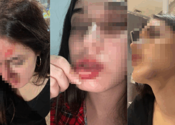 Eski sevgilisi tarafından darbedildiğini iddia edip, fotoğraflarını paylaştı