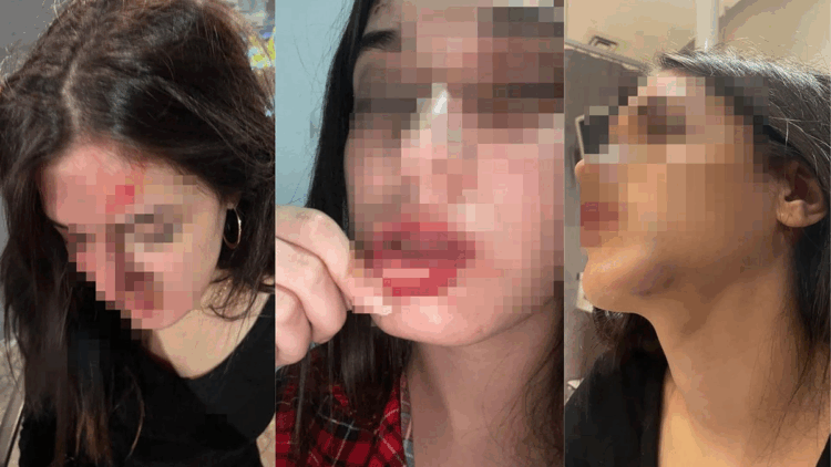 Eski sevgilisi tarafından darbedildiğini iddia edip, fotoğraflarını paylaştı