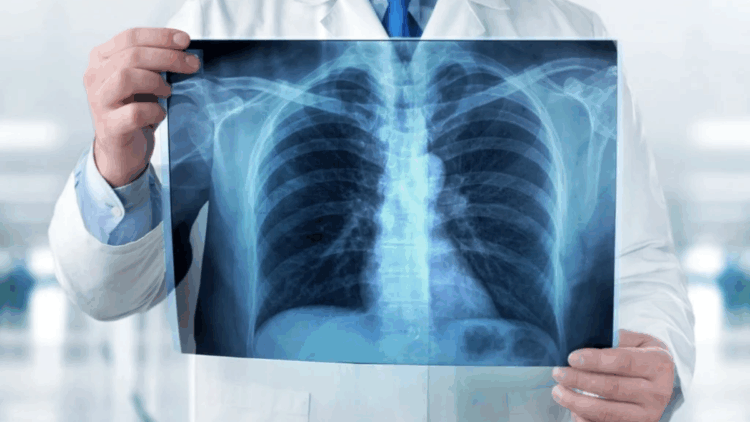 Her 5 kanser ölümünden 1'inde akciğer kanseri neden oluyor