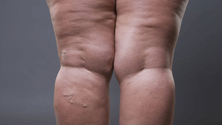 Lipödem, selülit gibi yüzeysel bir kozmetik sorun değil