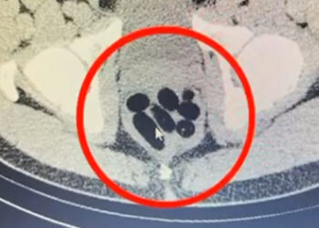 Midesinden kapsül halinde 500 gram metamfetamin çıktı
