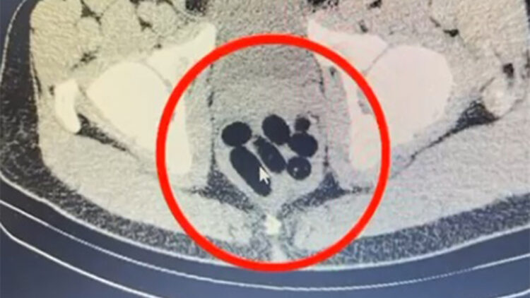 Midesinden kapsül halinde 500 gram metamfetamin çıktı