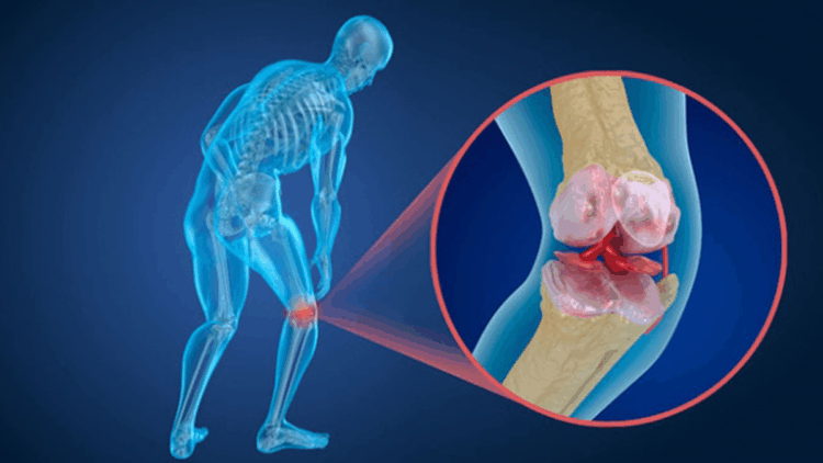 Menisküs yırtıkları her zaman ameliyat gerektirmiyor