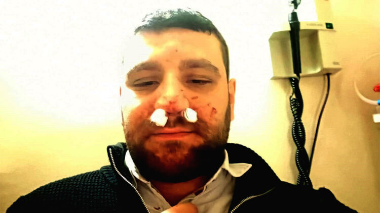 Avukat Mete Şahin'in yol verme tartışmasında burnu kırıldı